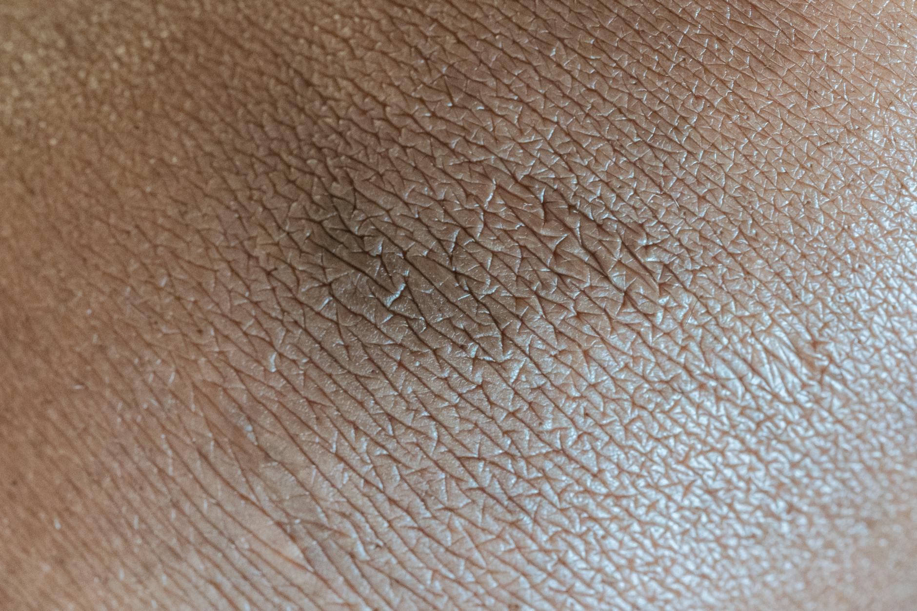 Textured background of skin surface with linear pattern and pigmentation spot in center - seasonal affective disorder symptoms