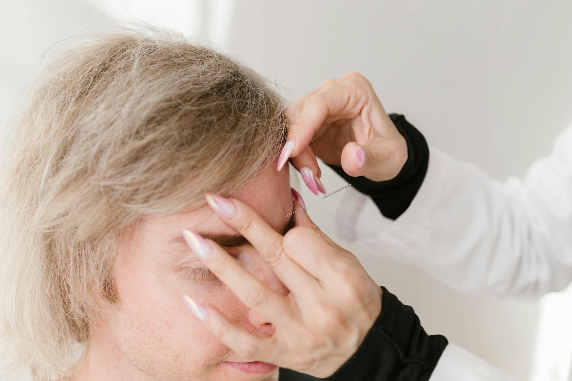 Close-up of acupuncture therapy, a holistic treatment for pain relief and wellness. - spring stress relief