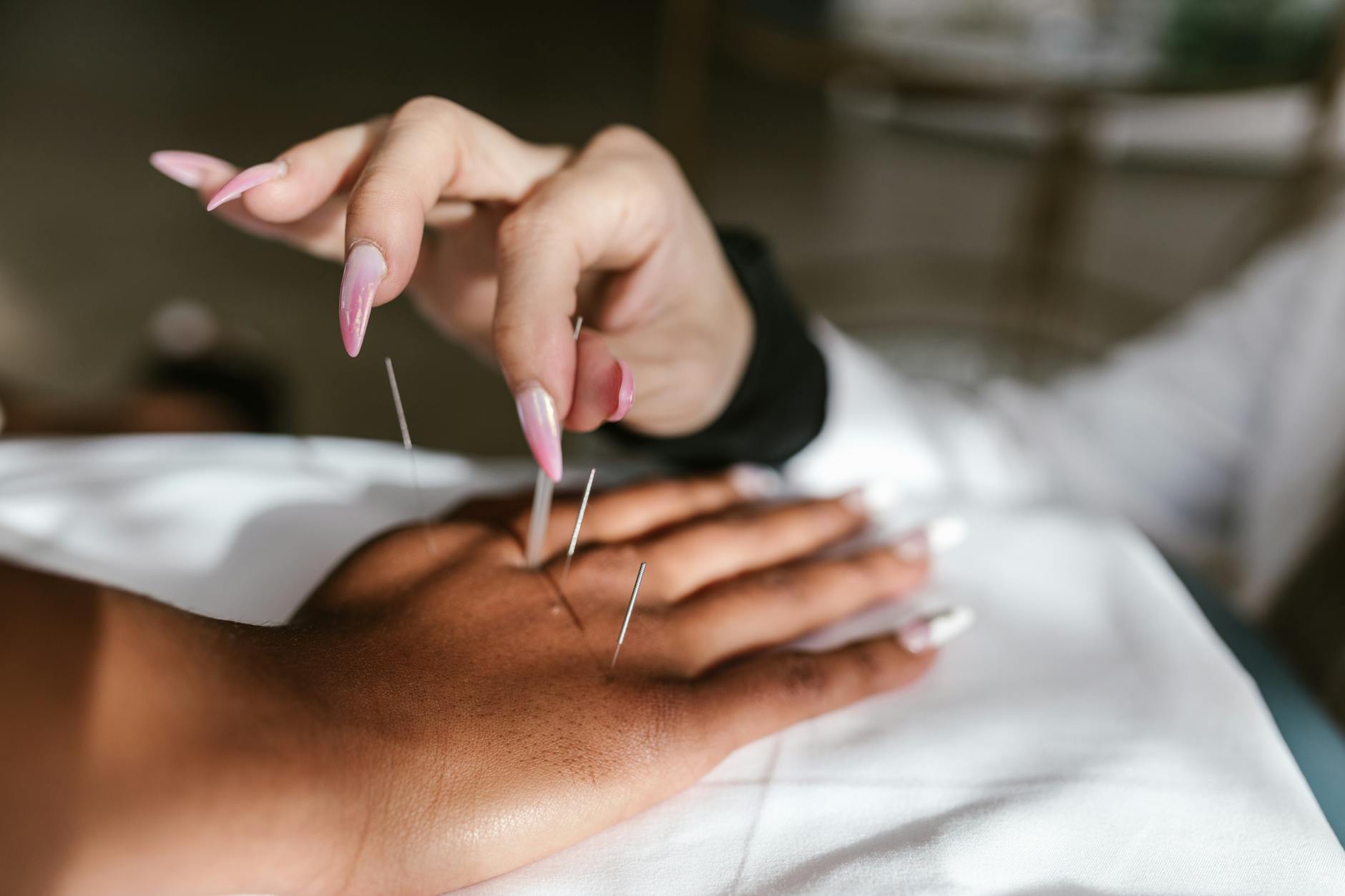 A detailed view of an acupuncture session for holistic health and wellness. - therapy integration skills
